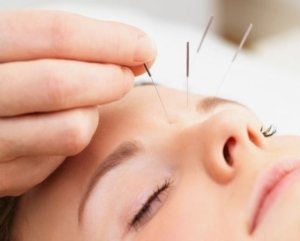 cosmetic acupunture